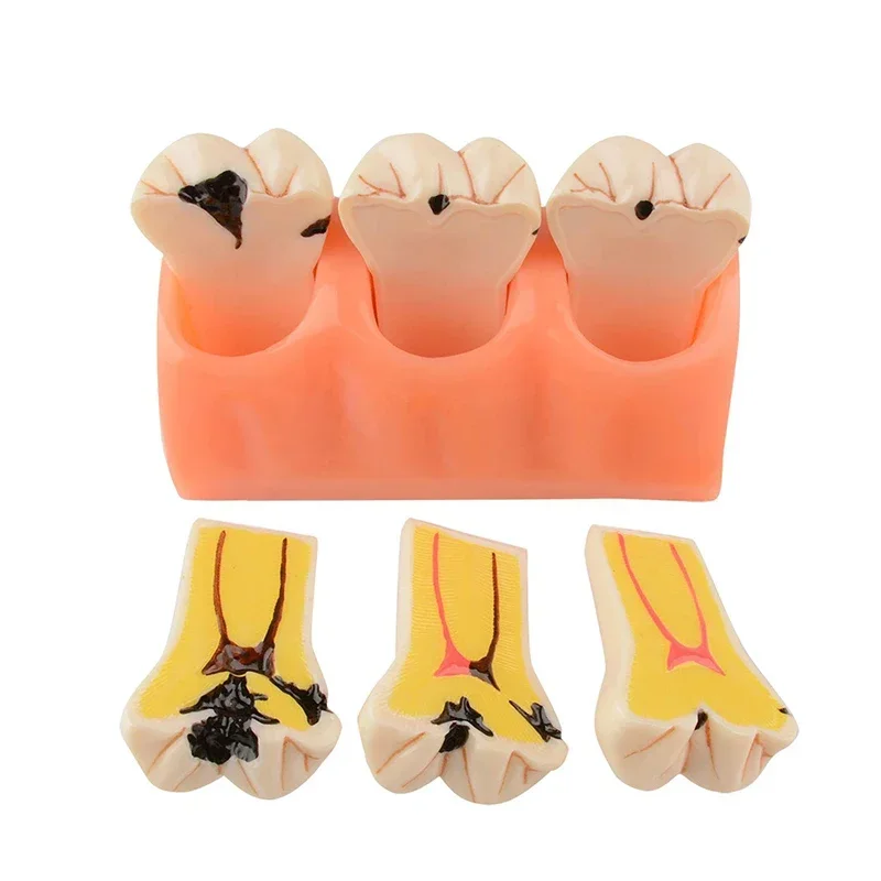 

Dentist Teaching Tools Dental Decayed Teeth Model Denture Caries Disease Tooth Model Decomposition Decay Tooth Model