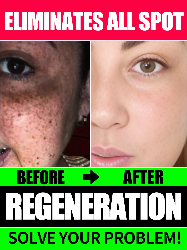 

Solve Your Melanosis Problems in 7 Days