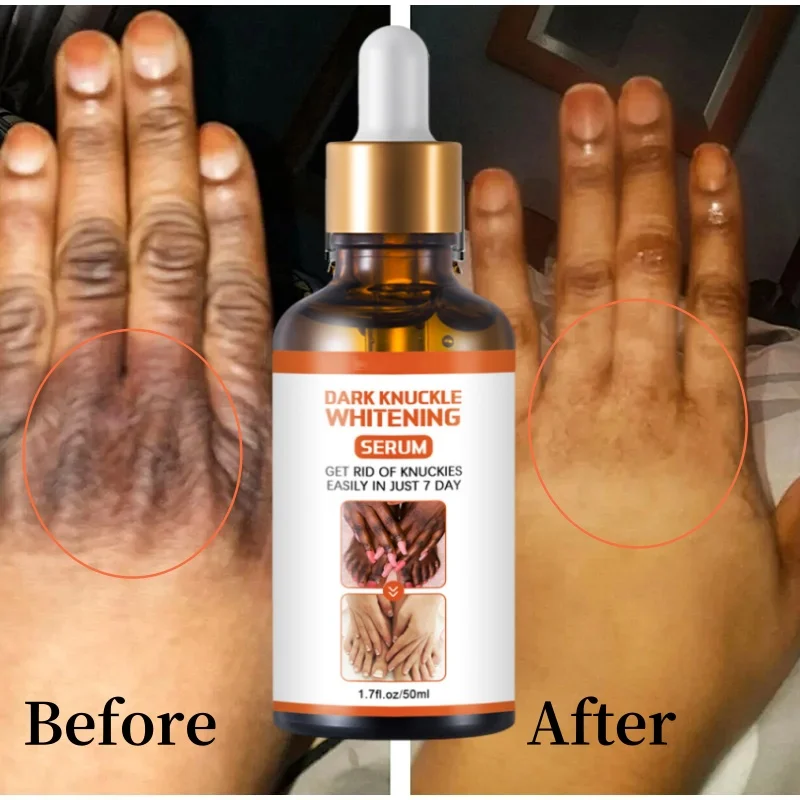 Black Skin Remover Essence Elbows Hand Dark Knuckle Fast Brightening Serum Lightening Glow Recipe Skincare Body Safety  Products