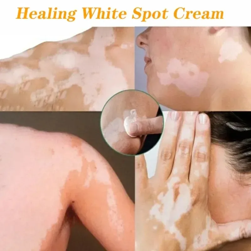 Pomada de extracto de hierbas de Vitiligo, crema de tratamiento para eliminar manchas blancas de la piel, elimina el Vitiligo