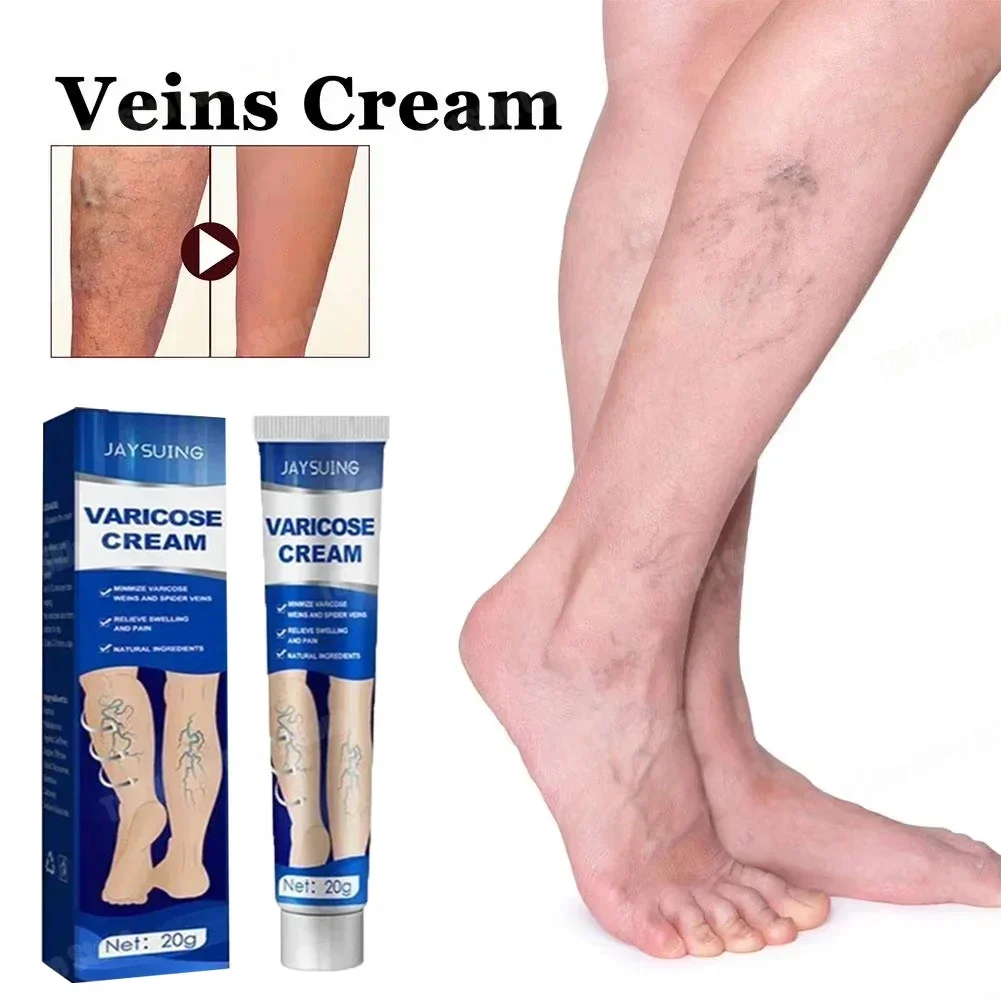 Creme reparador de veias varicosas alivia efetivamente a dor nas pernas e a creme de tratamento de vasculite