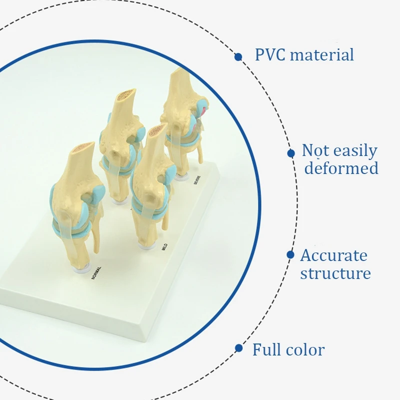 Anatomical Human Degenerative Knee Joint Model Skeleton Anatomy Teaching Resources