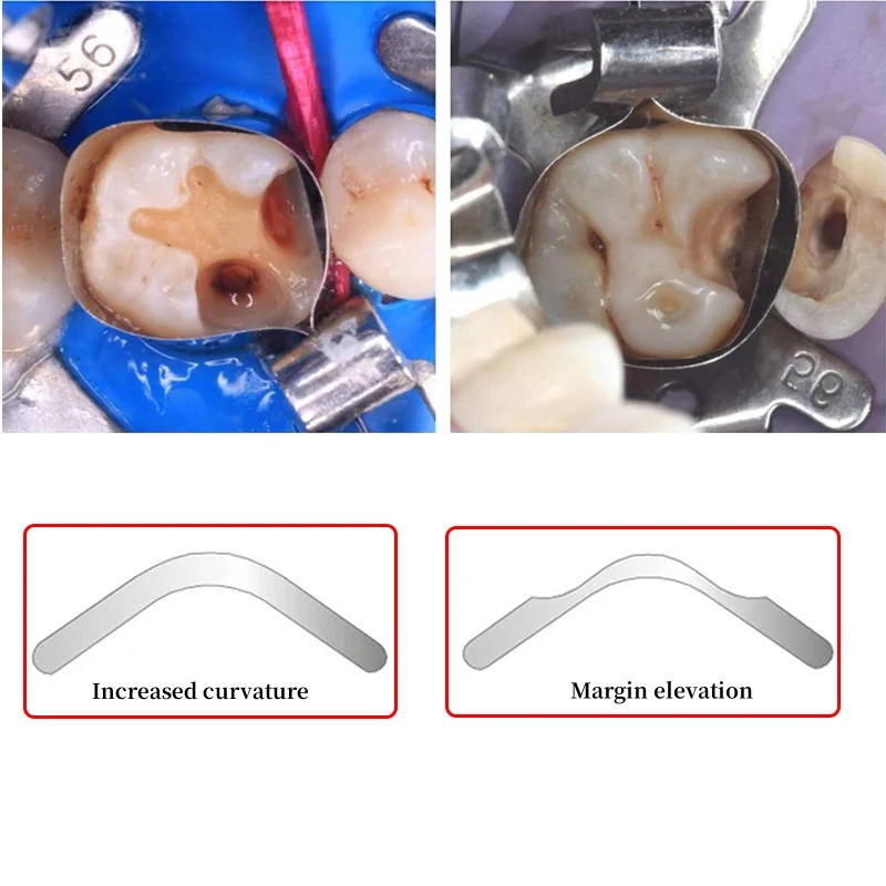 Bandas de matriz Dental de piezas, material de odontología, matriz Gingival, gran curvatura seccional contorneada, 100