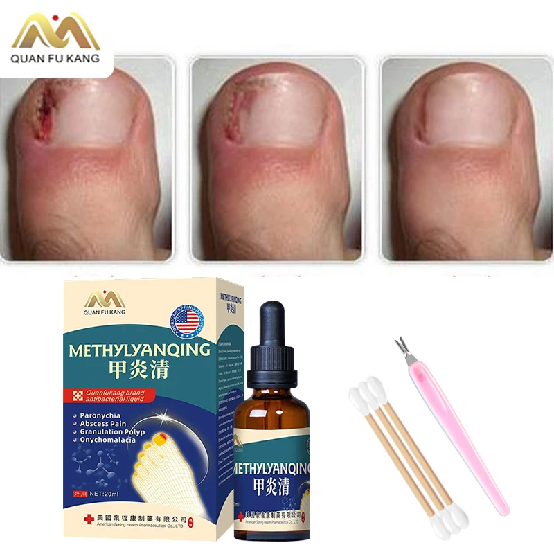 

Paronychia Treatment Liquid American Formula Nail Fungus Cleaner Nail Ingrown Correction Onychomycosis Toenail Fungal Care Tools