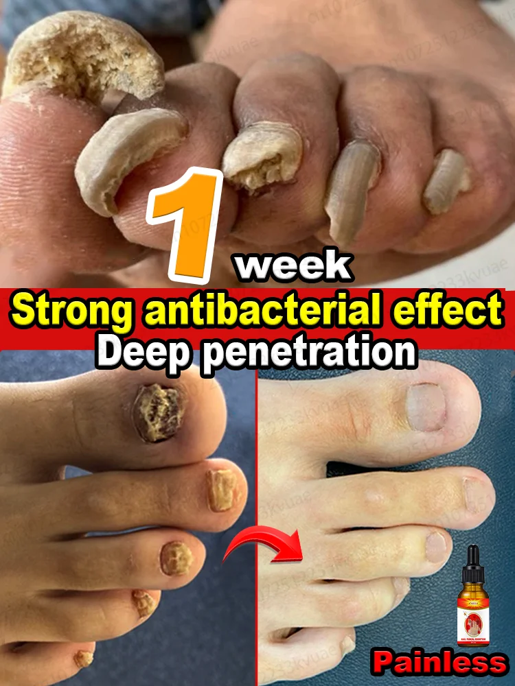 Você ainda sofre de dor nas unhas? Leva apenas 7 dias para matar bactérias rapidamente e recuperar sua confiança.