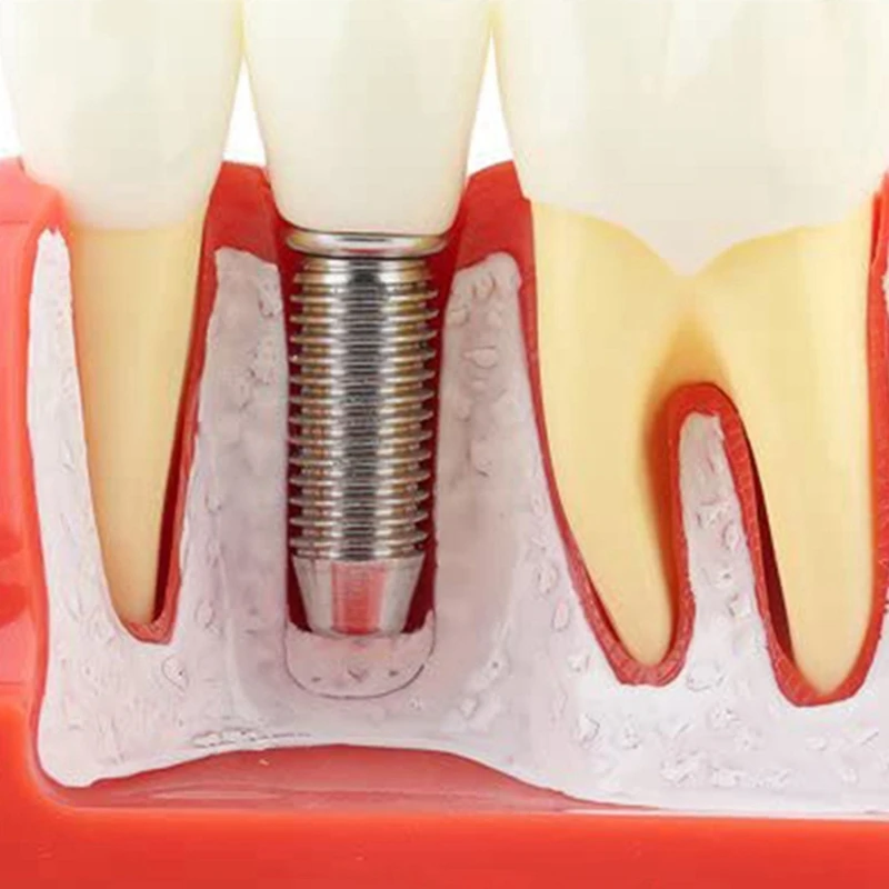 Modèle de Démonstration des Dents Implant PerfecAnalysis Couronne Pont pour la Communication-Patient