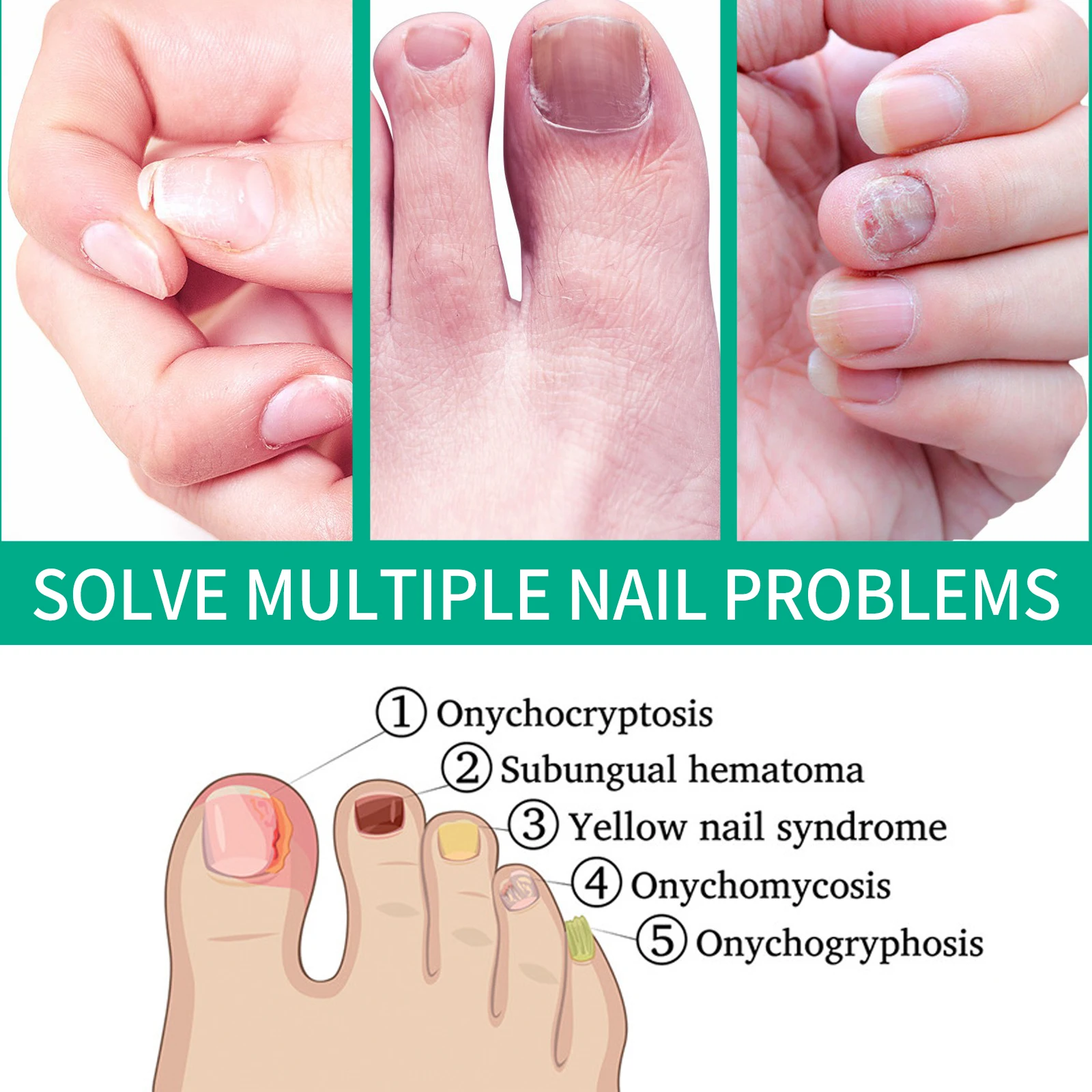 Toenail Fungus TreatmenT for Thick, Broken, Discolored and Damaged Nail 30ml