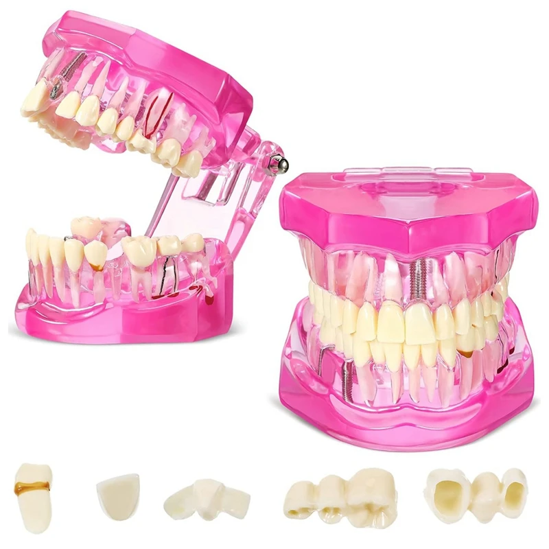 

Typodonts Implant Teeth Model With Removable Teeth Pathological Demonstration (Pink,2 Pcs)