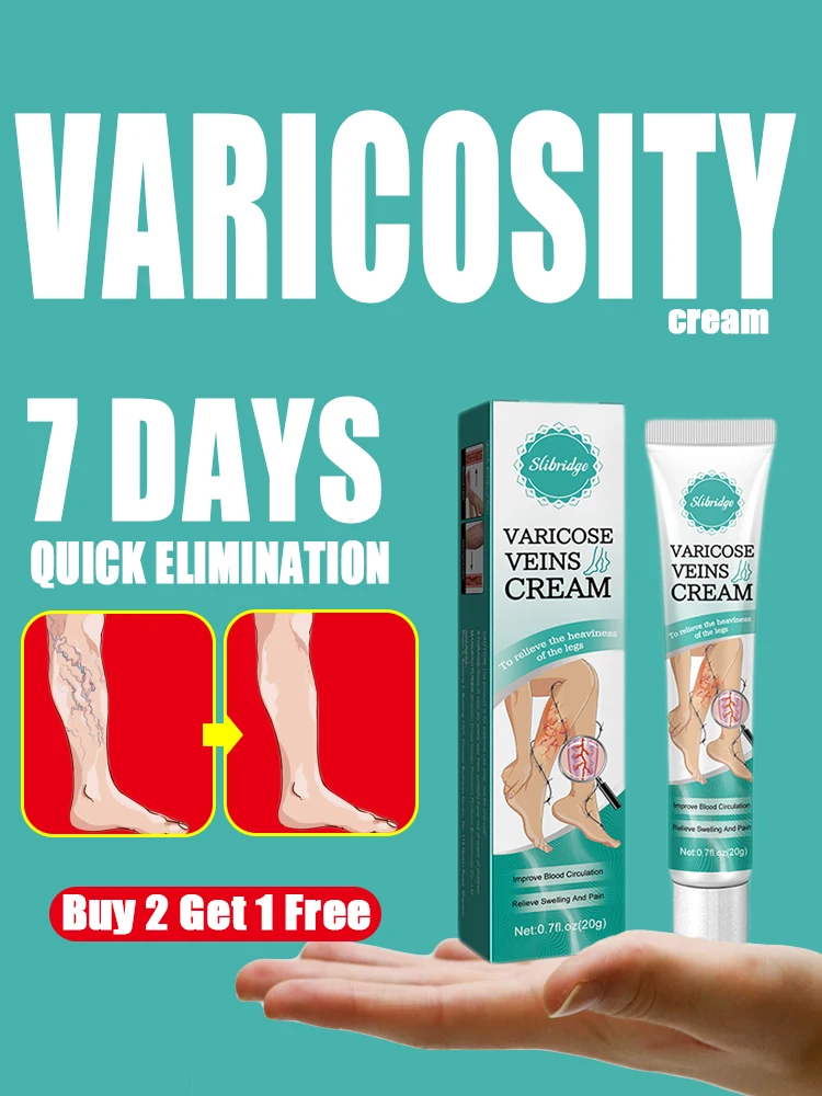 varicosity cream