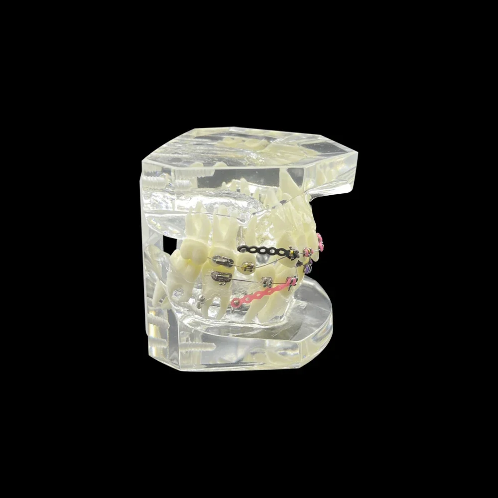 Orthodontic Dental Model With Anchorage Nail Metal Bracket Ortho Teeth Model Transparent Typodont Jaw For Teaching Studying Demo