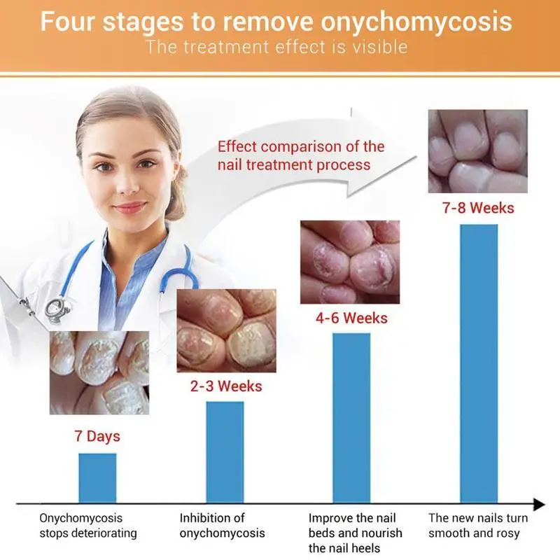 15 مللي LANBENA علاج الأظافر الفطرية قدم الرعاية جوهر أداة إصلاح الفطريات مصل فطار الداحس إزالة صحية Infe L5Q2