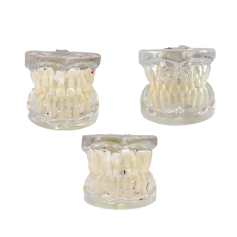 

Dental Clear Mixed Age Model with Caries Mixed with Missing Teeth Model Dental Teeth Model Dental Materials