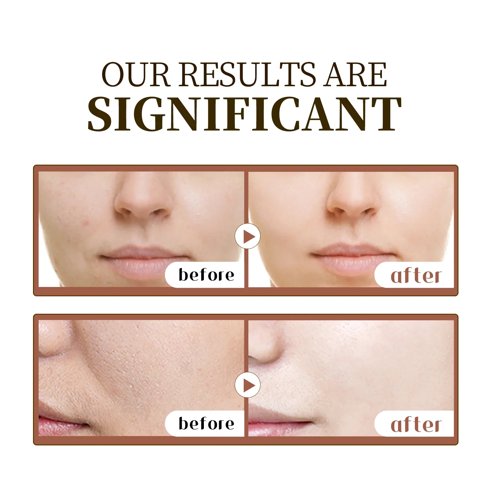 مصل مدغشقر كينتيللا اسياتيكا 55 مل - تركيبة مهدئة للبشرة الحساسة مع قتال حب الشباب، فوائد ترطيب عميقة للوجه