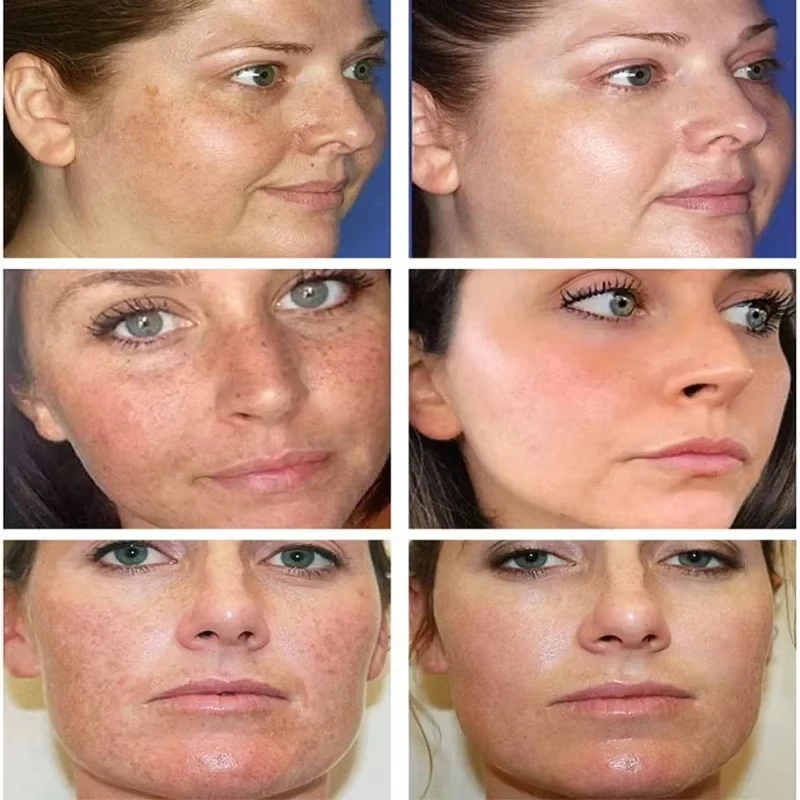 Effectieve Whitening Sproet Crème Verwijderen Melasma Melanine Donkere Vlekken Crème Hydraterende Voedende Fleuren Glad Gezicht Huidverzorging