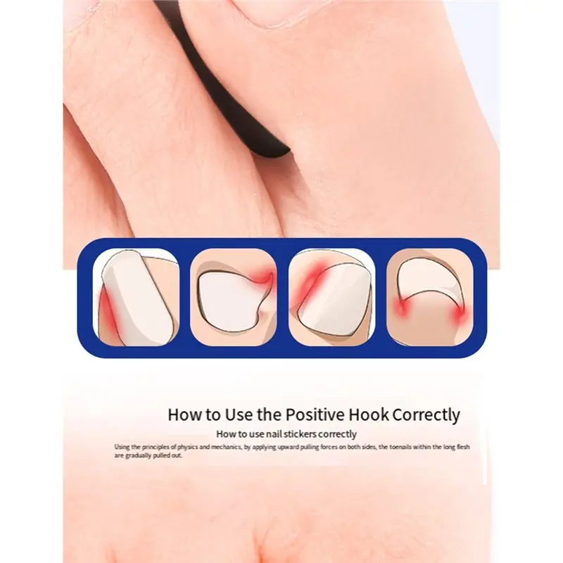 [NEWA66Z!】 Professional Ingrown Toenail Correction Corrector Tools Foot Care Tool For Pedicure Recovery Embedding Toe Nails