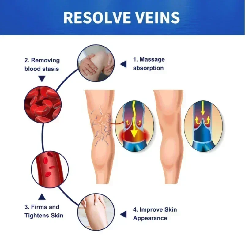 ใหม่เส้นเลือดขอดซ่อม Tongmai ที่มีประสิทธิภาพบรรเทาขา Bulge Pain Treatment Vasculitis Phlebitis ลบหลอดเลือดดํา 77