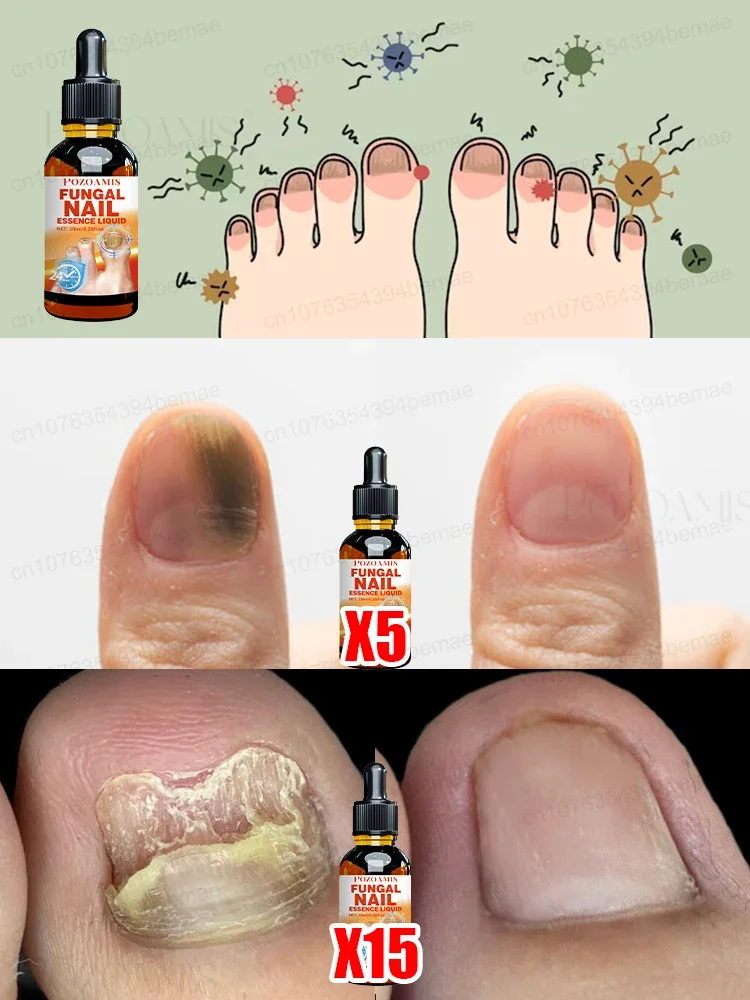 Solve the problem of onychomycosis