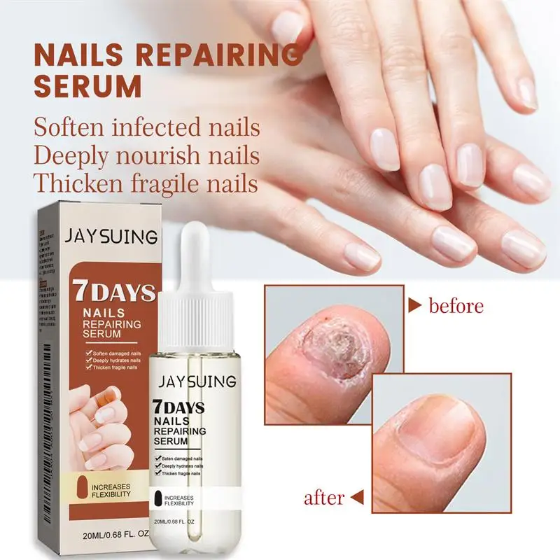 Nail Repair Serum 7 Days Repair 2ml Strong Nail Fungus Treatment Toenail Repair Serum Anti-infective Toe Fungus Removal