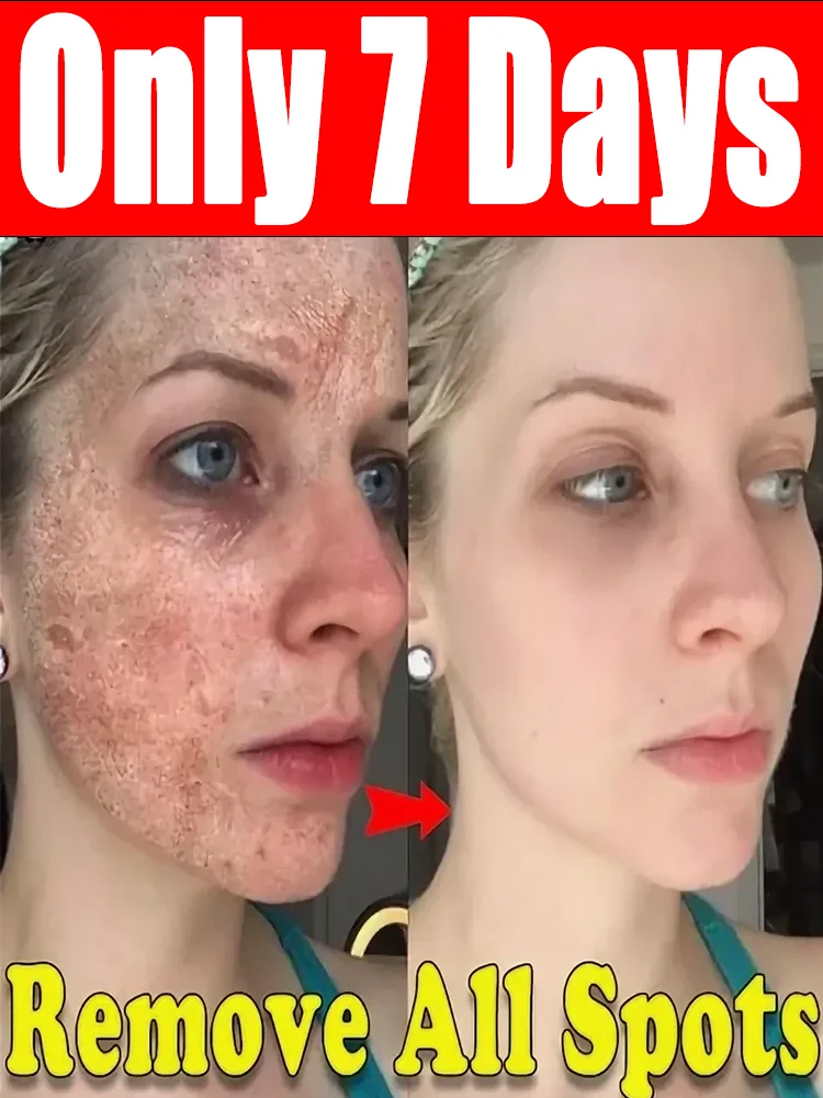 

Rᴇᴍᴏᴠᴇ ᴠᴀʀɪᴏᴜs sᴘᴏᴛs Dark marks fade away—reveal your inherently flawless skin. Skin care tools