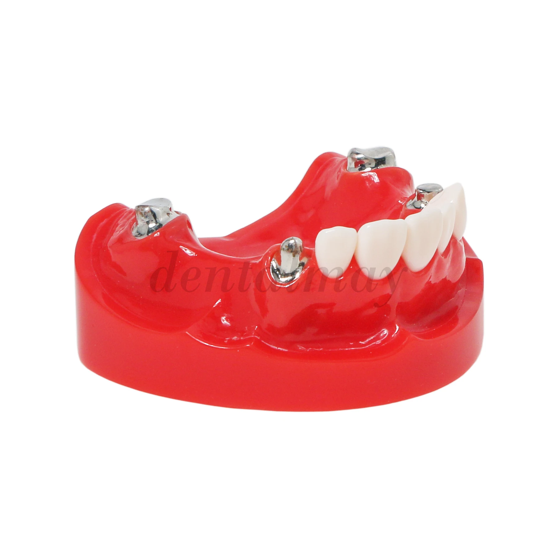 Dental Typodont Teeth Model with telescope Crown Prosthetics Teeth Models M6010