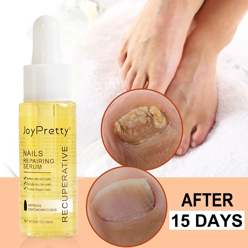 

JoyPretty Nail Treatment Serum Foot Repairing Essence Care Nourishing Toenail Finger Cuticle Oil Nail Care Products