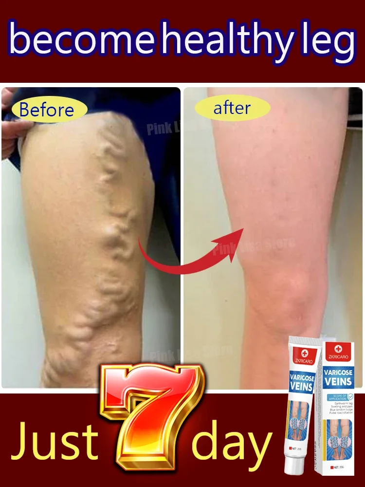 Varicose Vein Repair Hot Selling