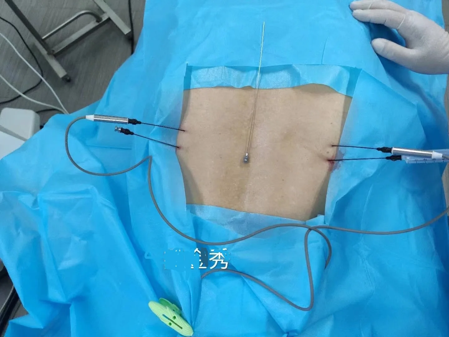 Radiofrequency Thermo Lesion Generator For Pain Management Neurosurgical instruments