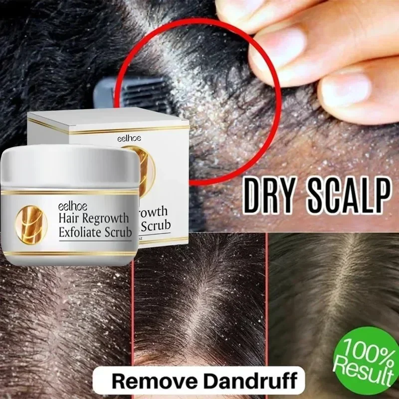 

Fast Anti Exfoliating Scrub Remove Dandruff Anti Itching Treatment Seborrheic Scalp Oil Control Repair Scalp Beauty Health Care