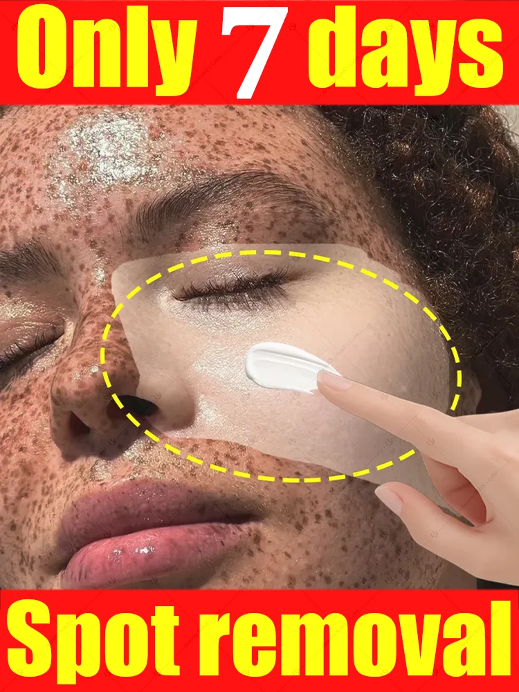 

Powerful cream dissolves facial freckles