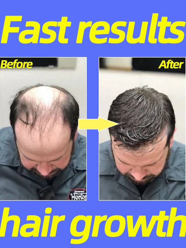 

Hair Growth Oil Repair Baldness Anti Hair Loss Hair Follicle Repair Fast Hair Regrowth