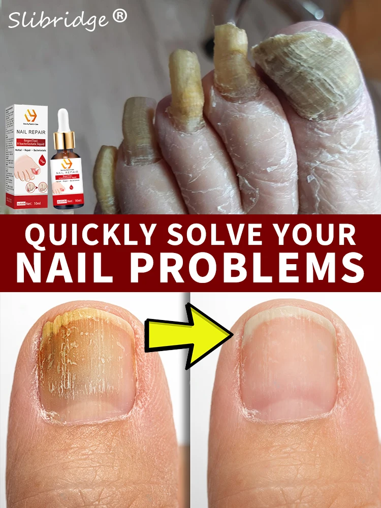 Fast nail restoration