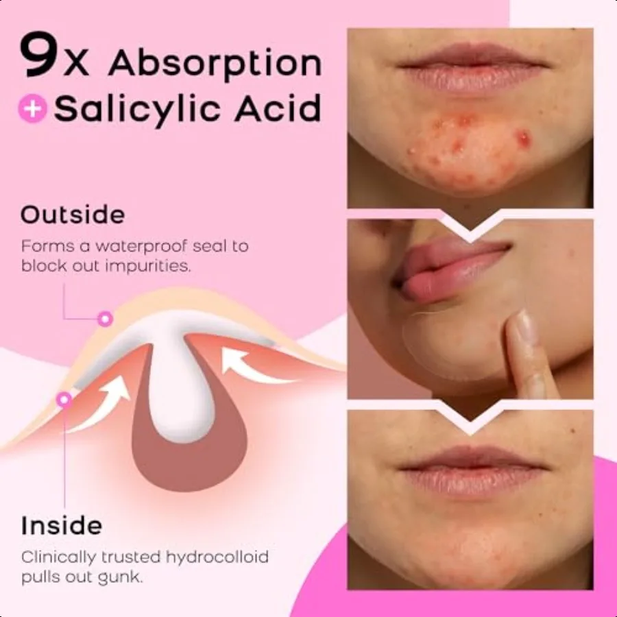 ハイドロコロイド顎ニキビパッチXL特大ニキビパッチ（顔、顎、体のニキビ用）ティーツリー、カレンデュラオイル配合（ニキビ跡用）