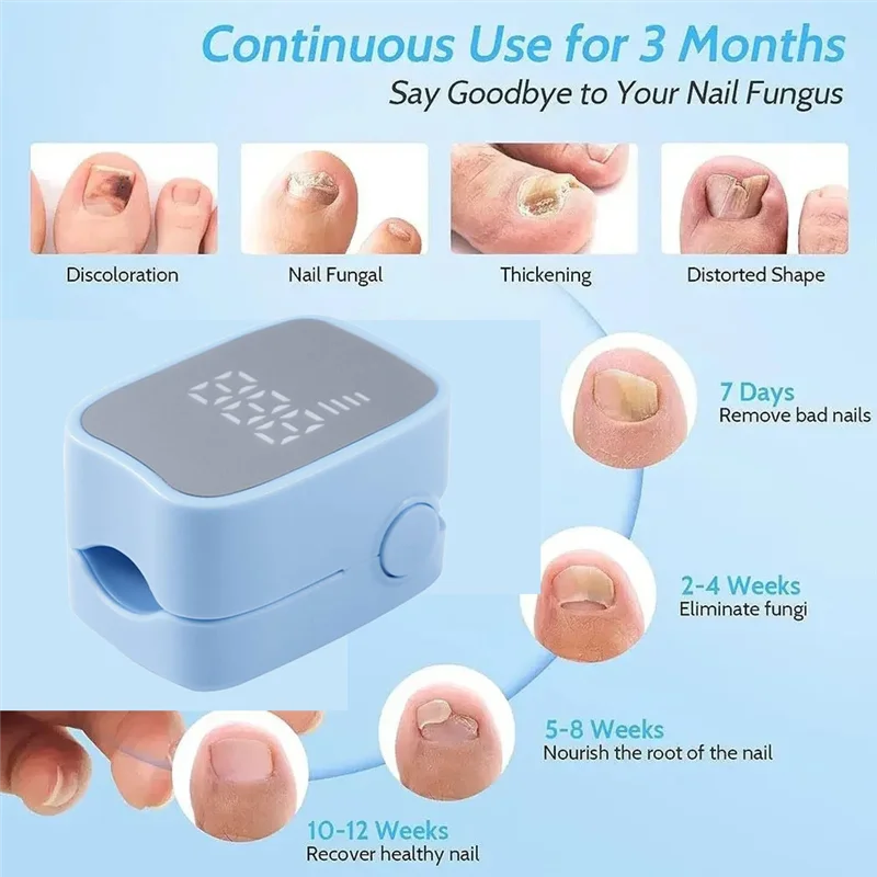 ไฟ LED สำหรับรักษาเชื้อราที่เล็บ สำหรับโรคเชื้อราที่เล็บ (Onychomycosis) - สำหรับเล็บมือและเล็บเท้า - อุปกรณ์ทำความสะอาดเล็บเท้า