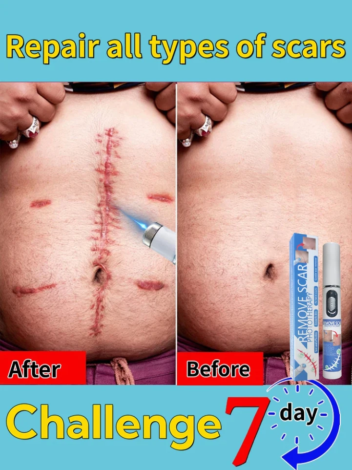 Laser Scar Hot· 𝐒𝐜𝐚𝐫 𝐫𝐞𝐦𝐨𝐯𝐚𝐥 𝐬𝐜𝐚𝐫 𝐫𝐞𝐜𝐨𝐯𝐞𝐫𝐲 𝐫𝐚𝐩𝐢𝐝 𝐫𝐞𝐦𝐨𝐯𝐚𝐥 𝐨𝐟 𝐬𝐮𝐫𝐠𝐢𝐜𝐚𝐥 𝐬𝐜𝐚𝐫𝐬