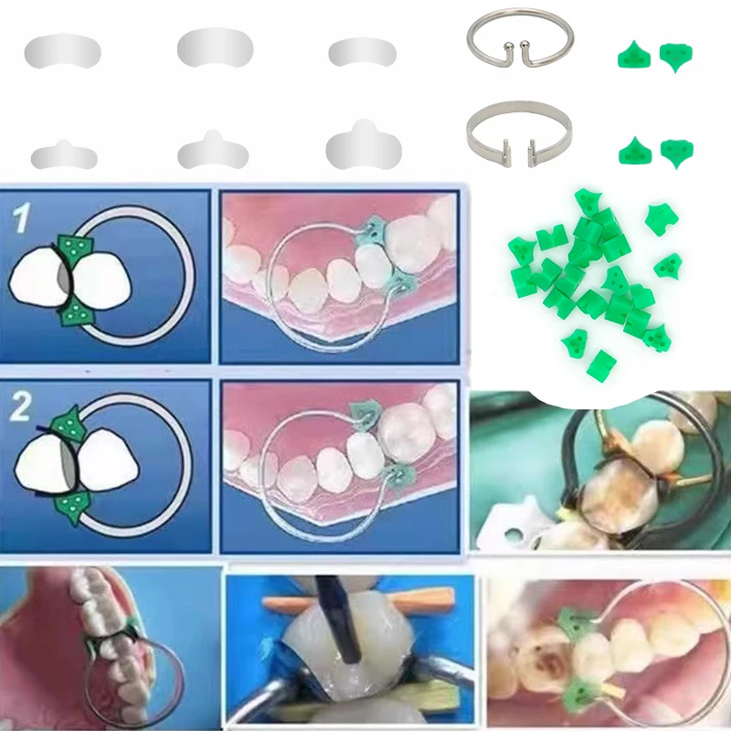 

100 шт./кор., стоматологическая матрица, секционные контурные металлические матрицы, ленты, плоскогубцы для смолы, зажимное кольцо, стоматологическая матрица, силиконовый клин