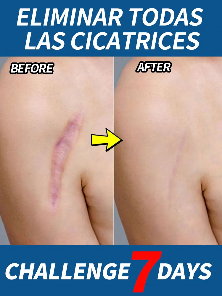 

Removing old surgical scars