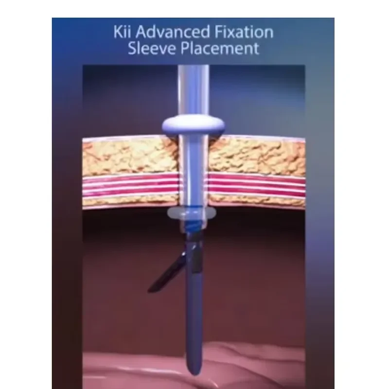 Advanced Fixation Disposable Balloon Trocar with Cannula 3-15mm Disk and Latex-free Balloon Sleeve