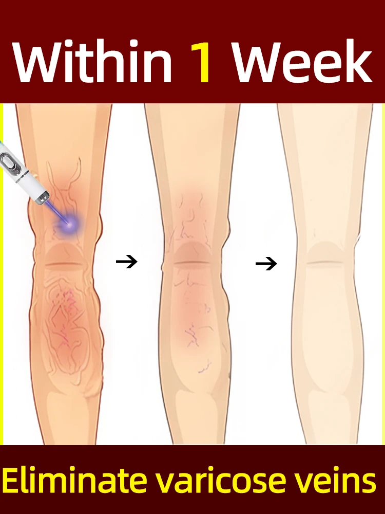 

blue light Save Varicose Veins Spider Legs in 7 Days for Men Women All People