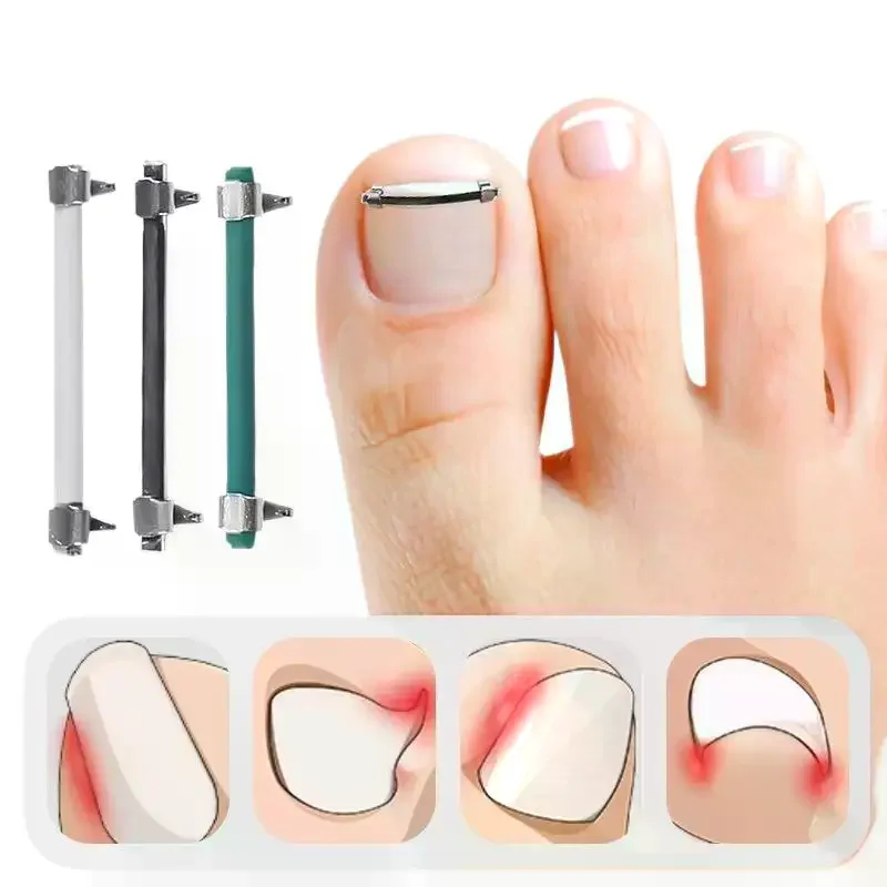 陥入爪矯正クリップ プロ仕様の湾曲したクランプ ペディキュアツール 陥入爪ケア＆埋没爪矯正用