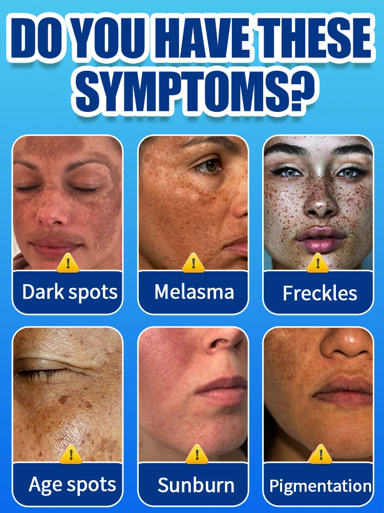 Remove freckles and whiten the skin, lighten and brighten facial dark spots