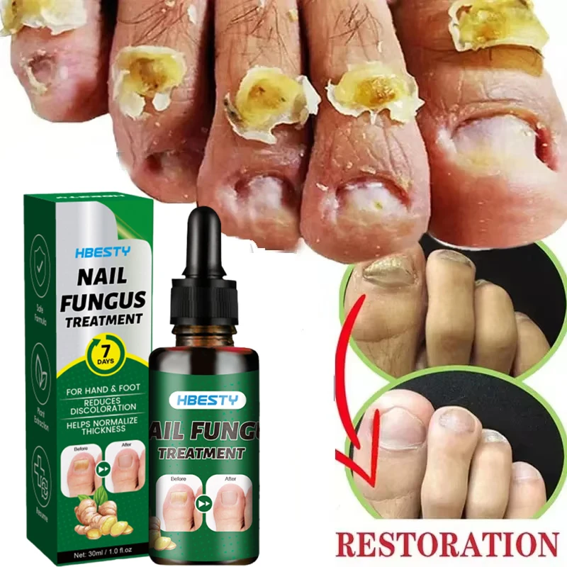 Nail Repairing Liquid Essence Hand Care Foot Fungal Removal Repair Serum Anti-infective Paronychia Nail Polish Repair Products