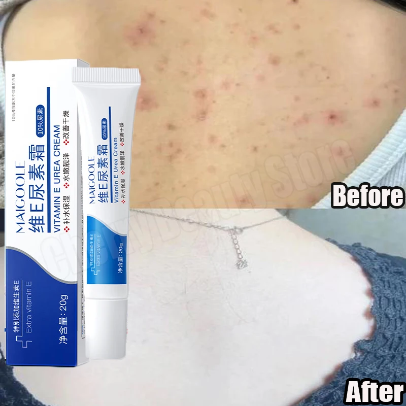 Körperaufhellungscreme, Keratose, Pilaris-Behandlung, holprig, raues Hühnerfollikel, Hautreparatur, Entfernung von Erdbeerbeinen, Pflege für trockene Haut