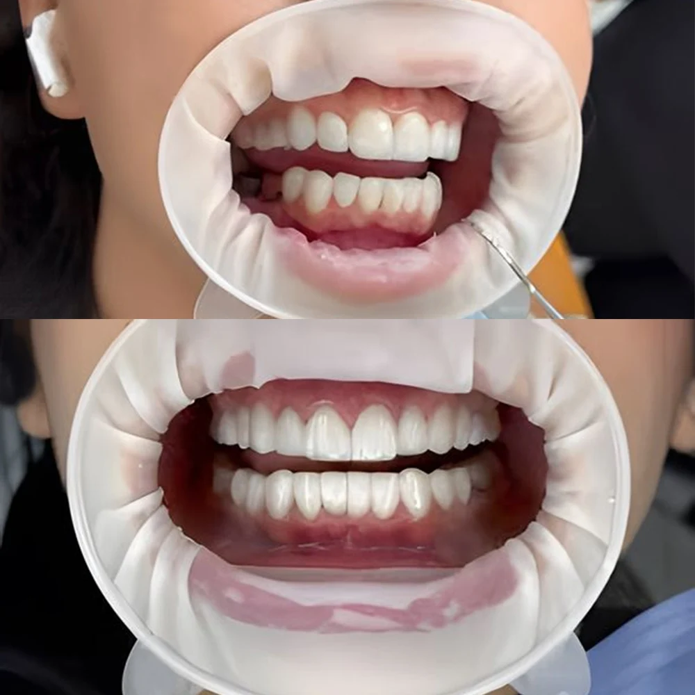 5pcs/10pcs O Shape Rubber Dam Dental Mouth Opener 3D Rubber Dam Retractor O Shape Prop Lip Cheek Expander Dentistry Materials
