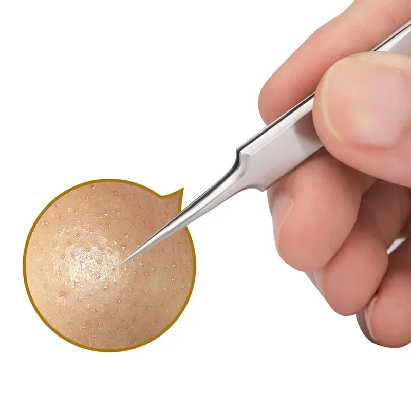 1 Stück Fein Nr. 5-Zellular-Akne-Mitesser-Pinzette, Zellen-Pickel, Mitesser-Clip, Gesichtsschönheit, Entfernung von Akne-Nadel-Werkzeugen für die Hautpflege