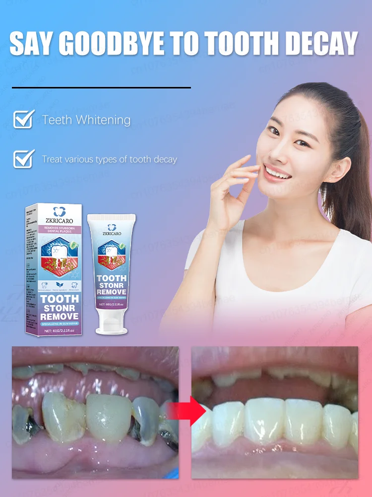 معجون أسنان لتبييض الأسنان - تركيبة إنزيم، إزالة البقع، التنظيف العميق، نفس منعش، شحن مجاني