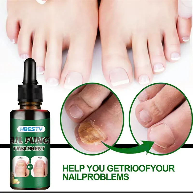 7 วันเชื้อราเล็บ Treatment เซรั่มขิง Anti-infective Paronychia Onychomycosis Toe เท้าเล็บ Fungal Repair GEL มือเท้า Care