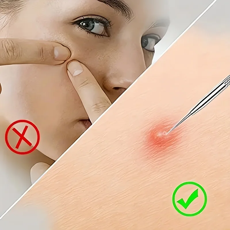 4ピースニキビ抽出セット、顔のニキビ、黒ずみ、ニキビを取り除くために使用され、肌を滑らかで柔らかくします。