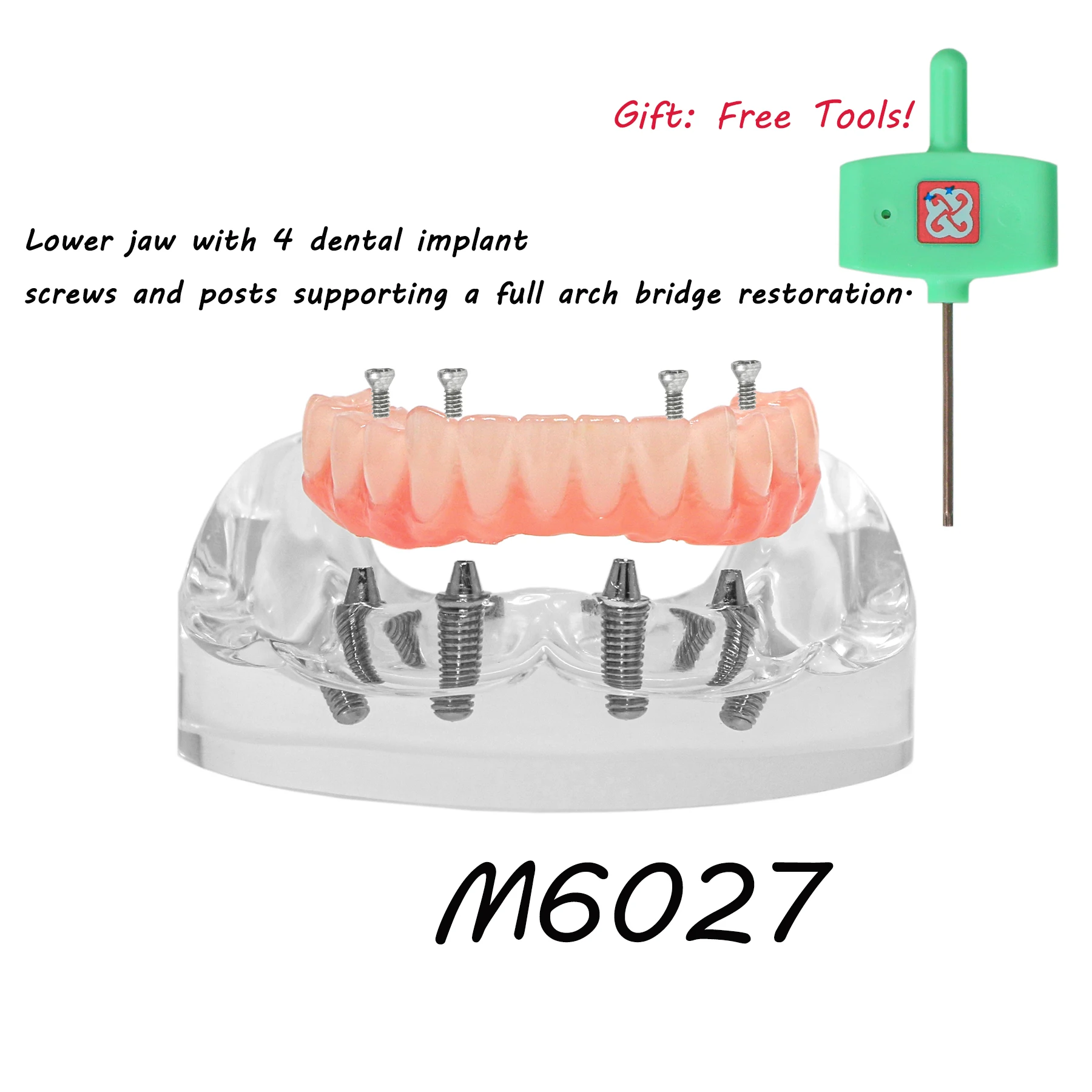 

Dental Teeth Model Lower Jaw Implant Restoration Overdenture Model 4 implant Screws Post Core Bridge M6027