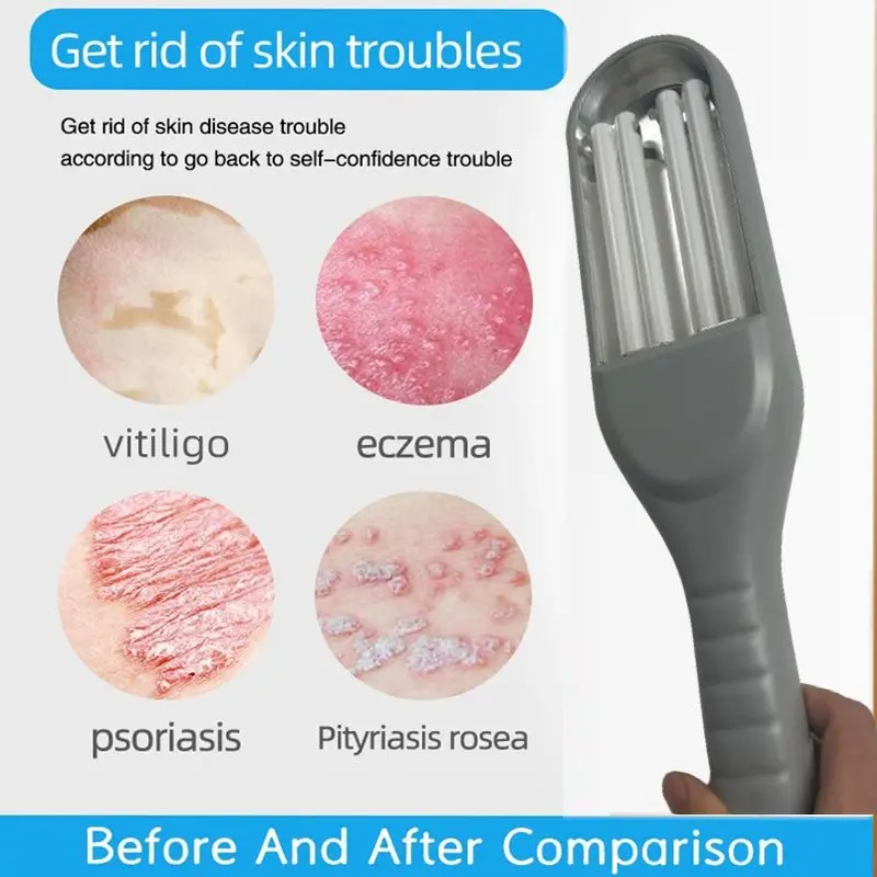

Home 311nm UVB Light Therapy Vitiligo Psoriasis Treatment 311nm Vitiligo Laser UV Treatment Dual UVB Lamp
