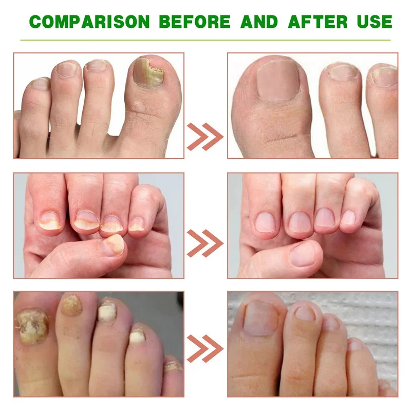 

Fungal Nail Treatment Serum 7 Days Fungus Removal Treating Paronychia Liquid Anti Gray Nails Infection Foot Repair Care Tools
